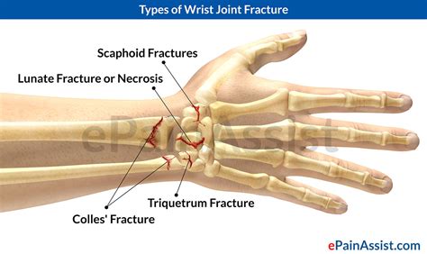Wrist Joint Fracturetypescausessymptomstreatment Medications Pt