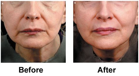 Using Laser Face Lift Treatment For More Beautiful Appearance