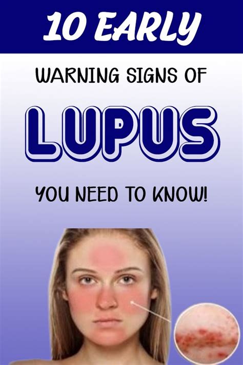 Here Are 10 Early Warning Signs Of Lupus You Need To Know Health