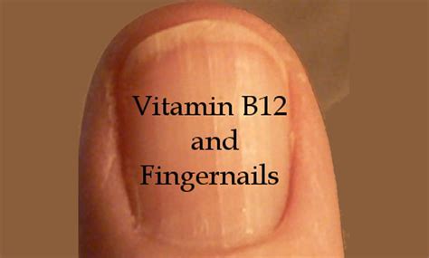 Stop ignoring these dangerous signs immediately!!! What Vitamin Deficiency Causes Weak Nails - Nail Ftempo