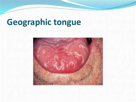 Tongue Disorders