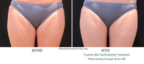 CoolSculpting Thighs Eliminate Inner And Outer Thigh Fat