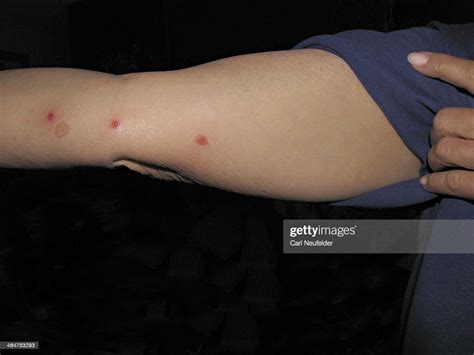 Blisters From Bed Bug Bites Foto De Stock Getty Images