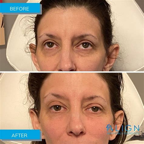 Before And After Under Eye Filler Align Injectable Aesthetics