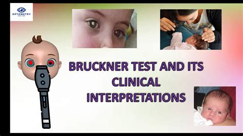 Bruckner Test And Its Interpretation Youtube