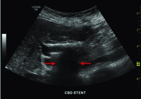 Us Image Showing The Indwelling Common Bile Duct Cbd Stent With
