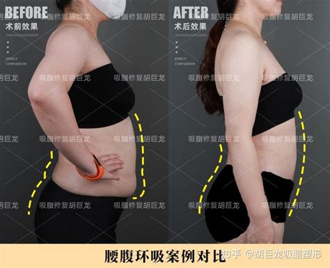 腰腹环吸妈妈臀吸脂塑形术后40天案例分享 知乎