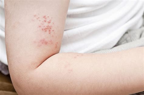 Skin Problems In Children Types Symptoms Complications And Remedies