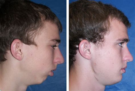 Before And After Case 20b Tmj Surgery Ankylosis Larry M Wolford Dmd