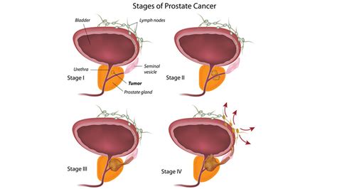 Prostate Cancer Biology Causes Stages And Treatment