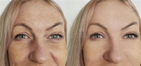 Woman Face Wrinkles Before And After Cosmetology Lifting Effect