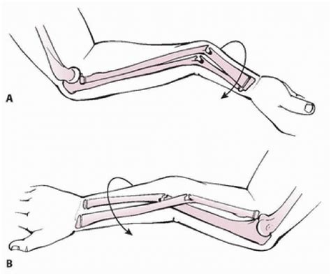 Closed Reduction And Casting Of Forearm Fractures Musculoskeletal Key