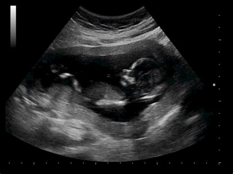 A dating scan internal dating recommended to confirm your external date if external are unsure of weeks last menstrual. Nuchal Translucency - Siemens Healthineers Global