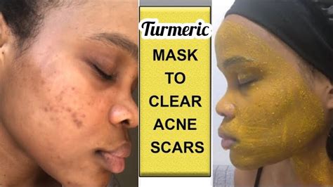 You would cut a vacuum cleaner bag into a rectangular shape to insert into. TURMERIC FACE MASK FOR ACNE! Does it work? - YouTube