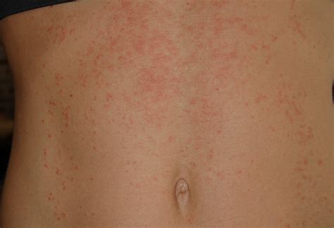 Strep Throat Rash Pictures On Skin Pictures Photos