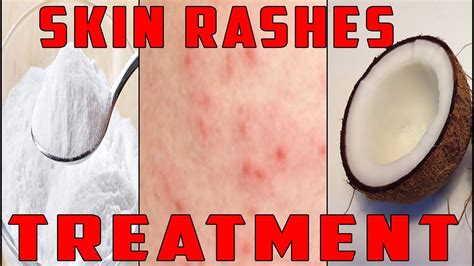 Skin Rash Treatment How To Treat Itchy Skin Rash Naturally Simple Images And Photos Finder