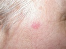 Topical skin cream for treatment of basal cell carcinoma shows promise ...
