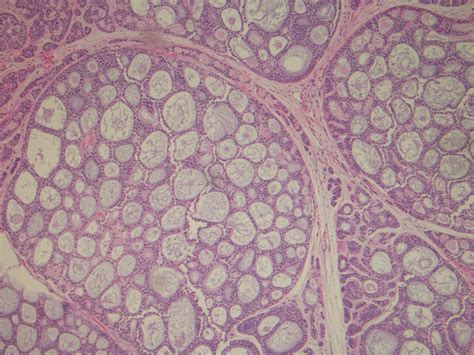 Adenoid Cystic Carcinoma Of Submandibular Gland Metastatic To Great