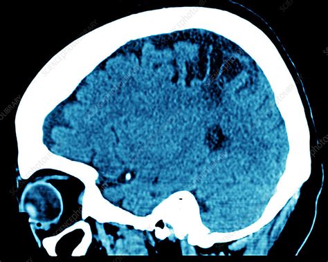 Cerebral Atrophy Ct Scan Stock Image C0254462 Science Photo Library