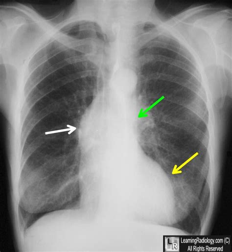 Stenosis Aortic Stenosis X Ray