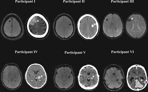 Cerebral Microbleeds Are Associated With An Increased Risk Of Stroke