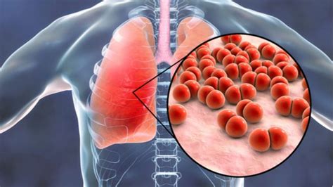 Simptom pnuemonia termasuk batuk, berkahak, demam, rasa letih dan sesak nafas. Radang Paru-Paru (Pneumonia)-Gejala, Punca Dan Juga ...