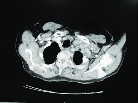 Ct Chest Shows Multiple Mediastinal Lymphadenopathy Ct Computed