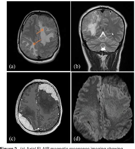 Figure 2 From Bifocal Intracanial Rosai Dorfman Disease Mimicking