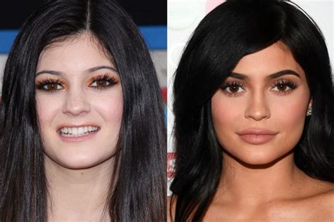 Kylie Jenner Plastic Surgery Truth Behind Transformation Revealed Ok