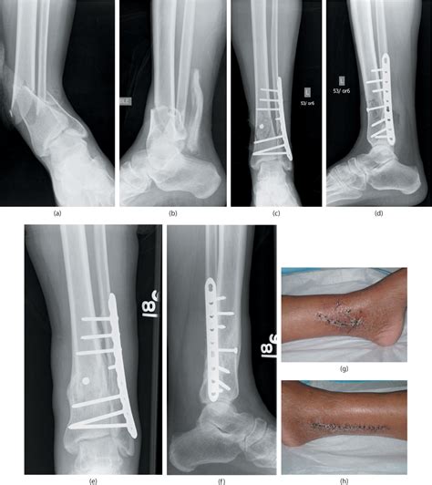 34 External Fixation Of Distal Tibial Fractures Musculoskeletal Key Images