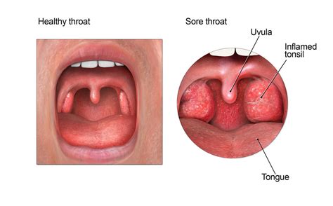 How To Cure A Sore Strep Throat Fast Public Health