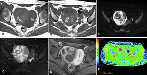Combination Of Clinical And Mri Features In Diagnosing Ovarian