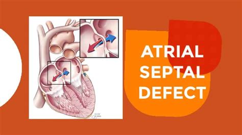 Atrial Septal Defect Definition Causes And Clinical Features