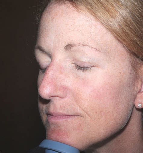 Before And After Pictures Of Actinic Keratosis In Cha