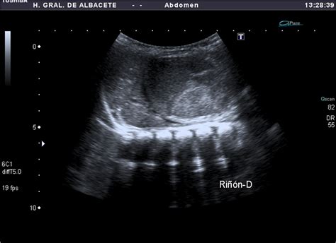 Paciente de 6 meses con masa palpable en flanco derecho.