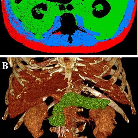 A Preoperative Axial Ct Image With Slice O Matic Body Composition