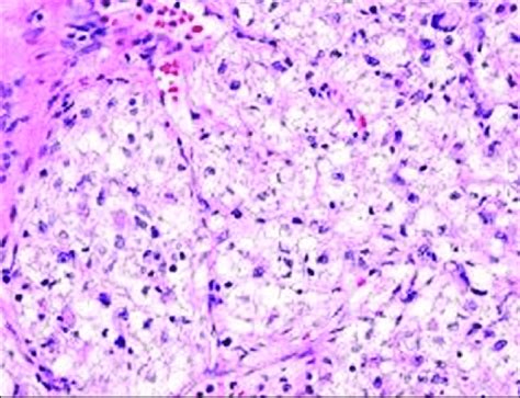 Histopathologic Findings Of Malign Perivascular Epithelioid Cell Tumor