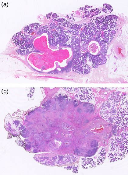 Mucoepidermoid Carcinoma Of The Parotid A Low Grade Lesion Com