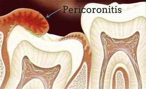 Causes Of Pericoronitis Aa Dental Clinic