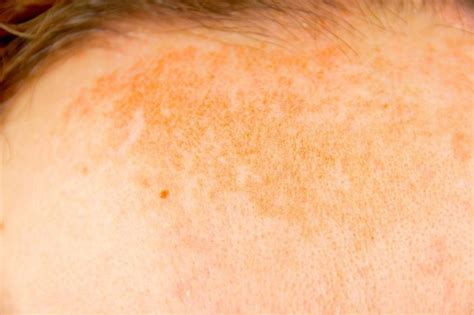 Hyper Pigmentation Dermatology Conditions And Treatments