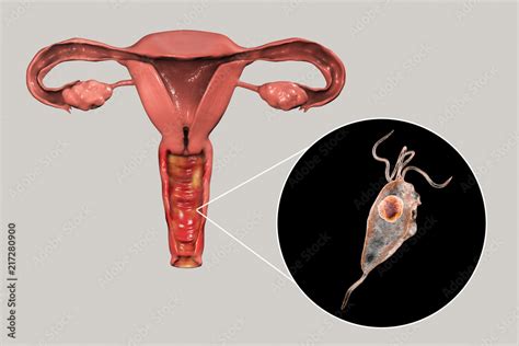 Female Trichomoniasis 3D Illustration Showing Vaginitis And Close Up
