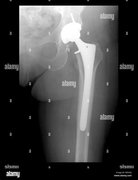 Hip Replacement X Ray Hi Res Stock Photography And Images Alamy