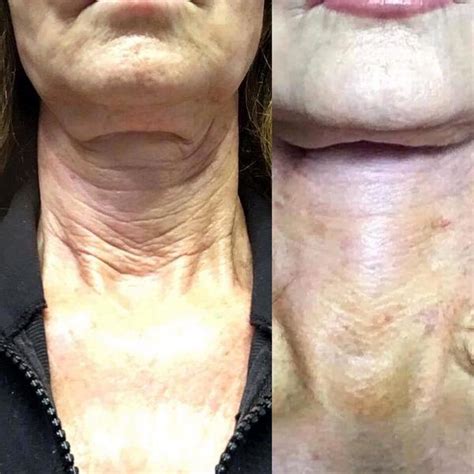 Botox Neck Treatment Pre And Post 1 Facial Injections Info Prices