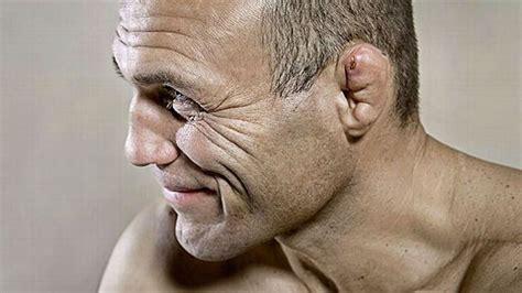 Do Boxers Get Cauliflower Ear What Is Cauliflower Ear And Does It Go