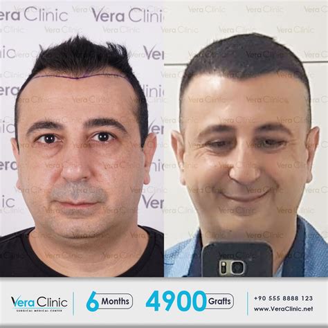Hair Transplant At Vera Clinic Is Operated By The Best Specialized