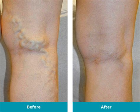 Spider And Varicose Vein Treatment Before And After Photos Yuma Az