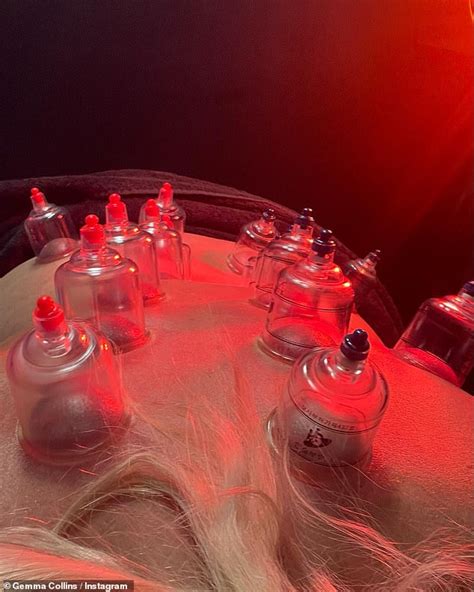 Gemma Collins Undergoes Cupping Therapy As She Enjoys A Pamper Session During Her Day Off