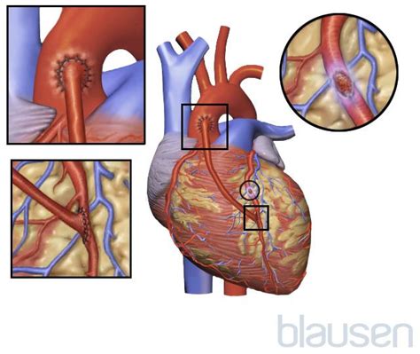 Image Coronary Artery Bypass Grafting Cabg Merck Manuals Consumer