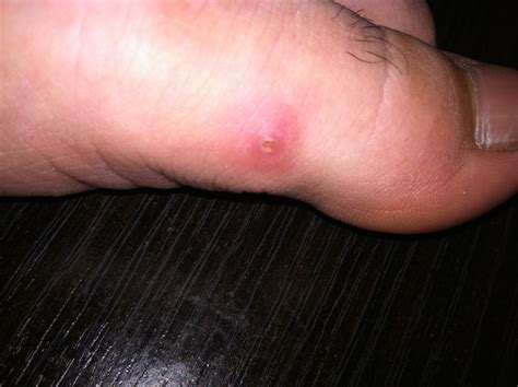 I Got This Bump On My Foot Right To The Side Of My Big Toe