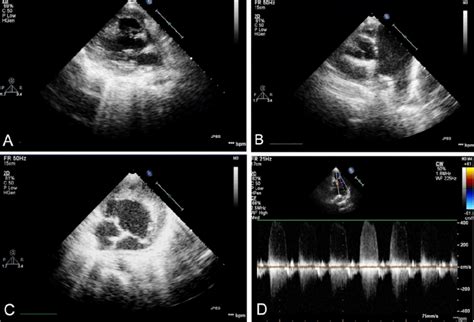 2d Echocardiography Showing Hypertrophy Of Left Ventricle A